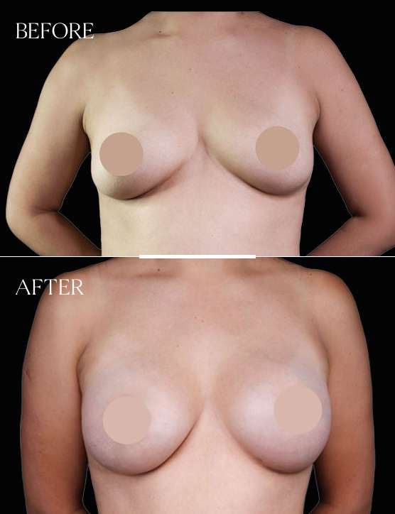 Breast Augmentation Case 1