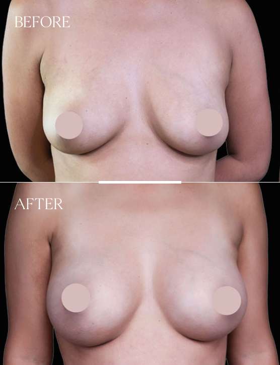 Breast Augmentation Case 2