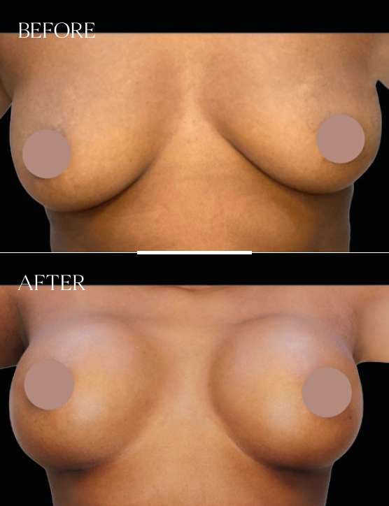 Breast Augmentation Case 3