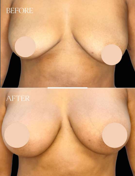 Breast Augmentation Case 4