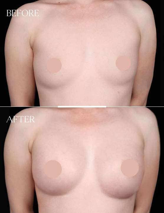 Breast Augmentation Case 5