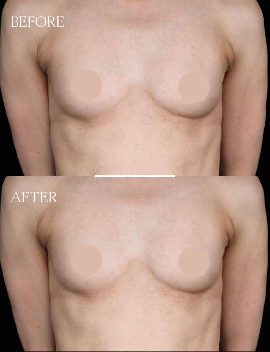 Breast Augmentation Case 6