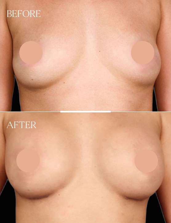 Breast Augmentation Cases