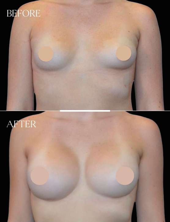 Breast Augmentation Case 8