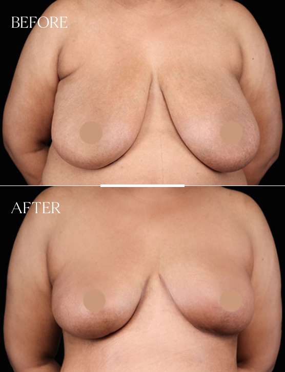 Breast Reduction Cases
