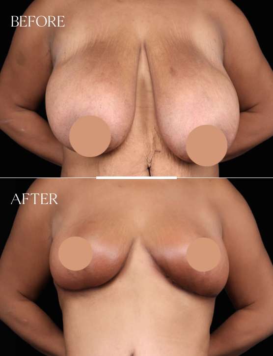 Breast Reduction Case 2