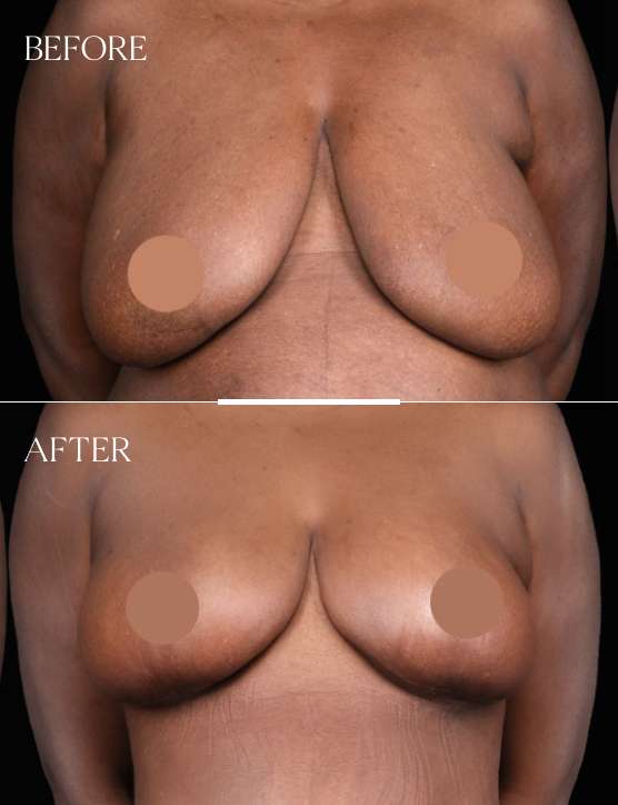 Breast Reduction Case 3