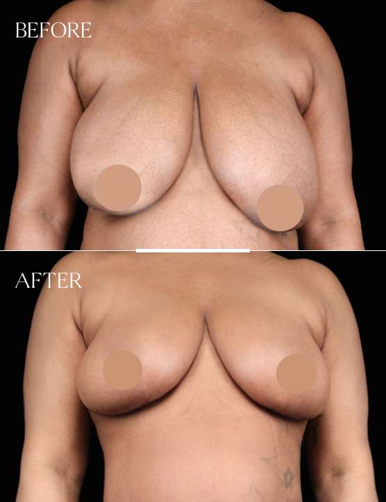 Breast Reduction Case 4