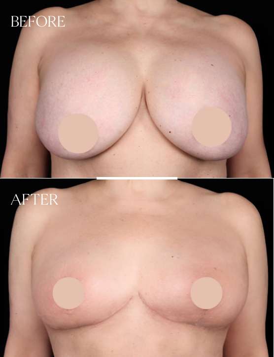 Breast Reduction Case 5