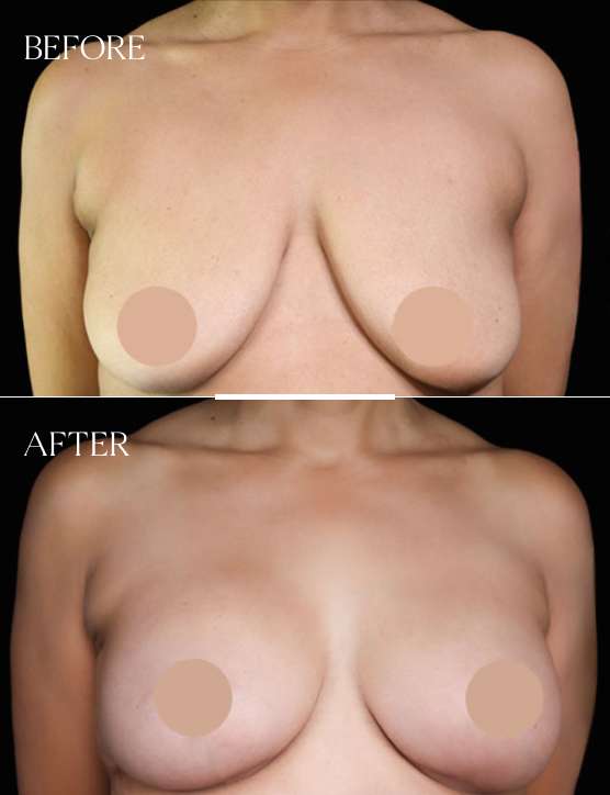 Breast Reduction Case 6