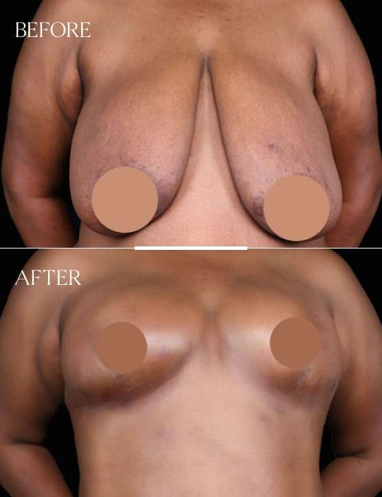 Breast Reduction Case 7