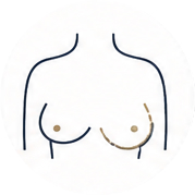 Breast revision