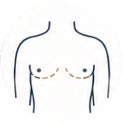 Male breast reduction