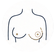 Nipple Reconstruction